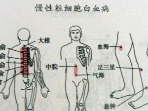 慢性粒细胞白血病