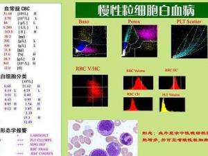 慢性粒细胞白血病