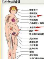 库欣综合征