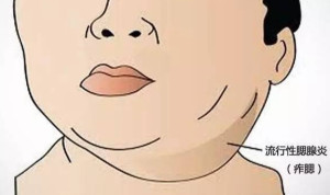 腮腺炎