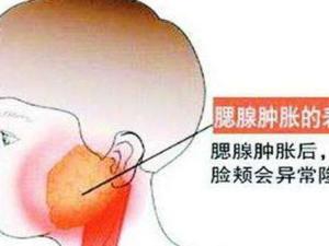 腮腺炎