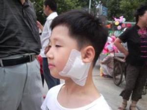 腮腺炎
