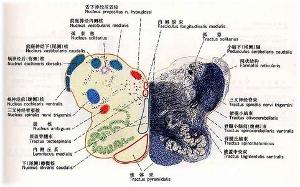 橄榄体脑桥小脑萎缩