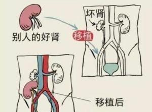 肾移植