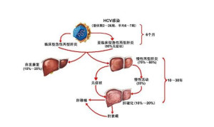 丙型病毒性肝炎