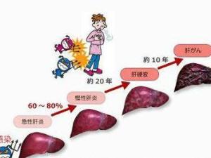 丙型病毒性肝炎