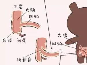 肠套叠