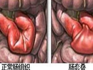 肠套叠