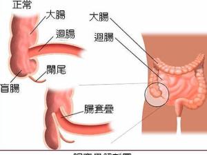 肠套叠