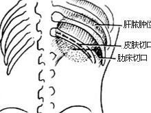 腹膜后感染与脓肿