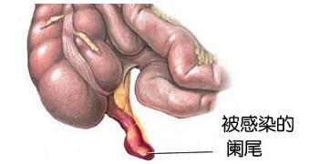 阑尾炎