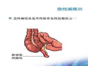 阑尾炎