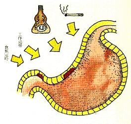 萎缩性胃炎