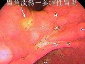 萎缩性胃炎