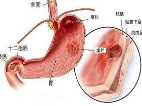 萎缩性胃炎