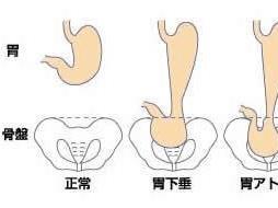 胃下垂