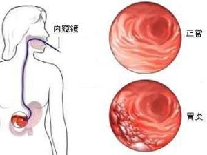 胃炎