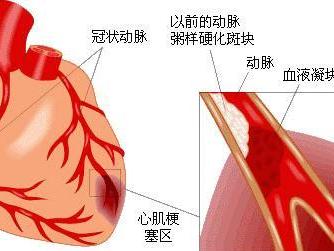 持续性交接区折返性心动过速