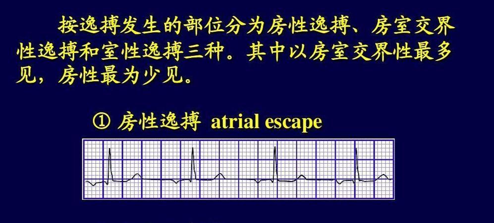 房性逸搏和房性逸搏心律