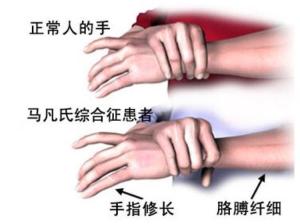 马方综合征