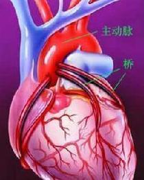 心肌桥