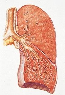 支气管扩张