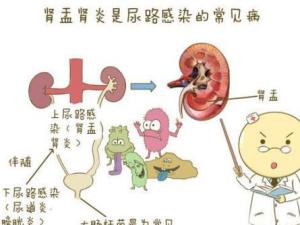 尿路感染示意图