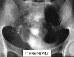 双侧输卵管