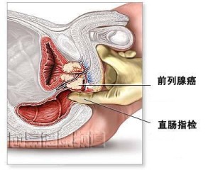 前列腺癌 指检