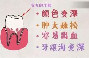 牙龈发炎