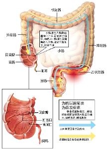 阑尾与其他