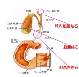 胆总管结石
