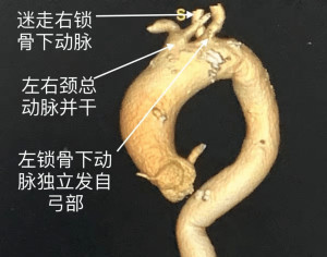 主动脉弓