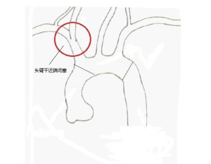 头臂干