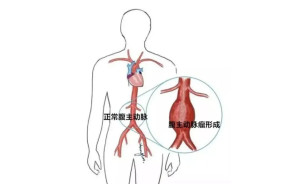 腹主动脉