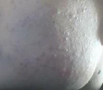 白头粉刺