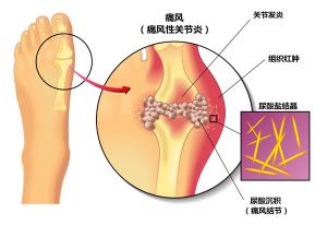 痛风石