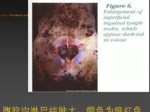 腹股沟淋巴结肿大