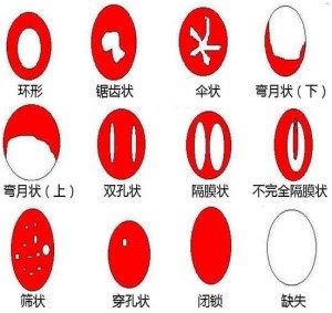 处女膜形态