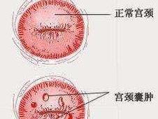 宫颈囊肿