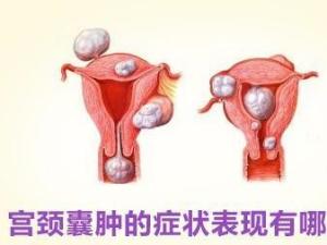 宫颈囊肿