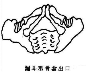漏斗骨盆