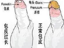 包皮粘连