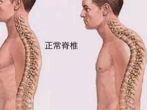 驼背