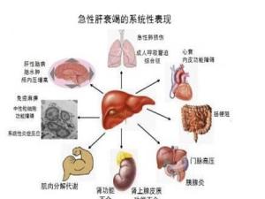 肝衰竭