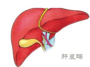 肝衰竭