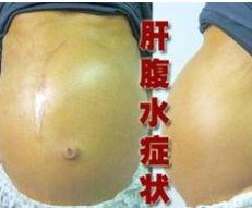 肝硬化腹水
