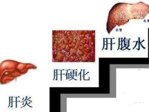 肝腹水