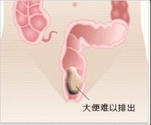 排便困难