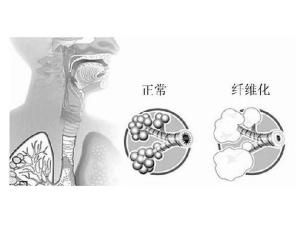 肺纤维化